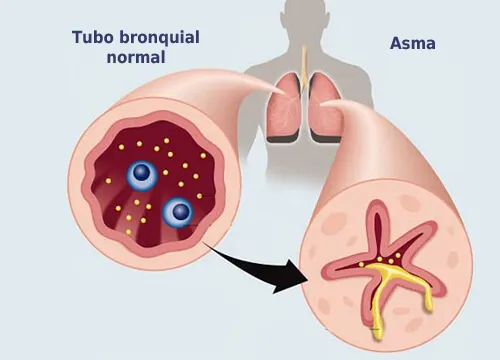 Remedios naturales antialérgicos