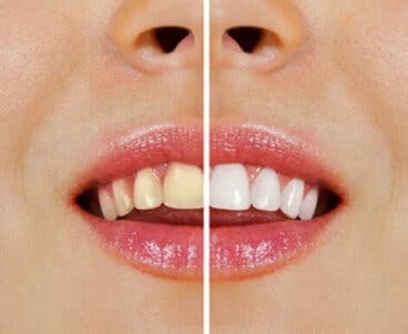 Productos naturales para blanquear los dientes