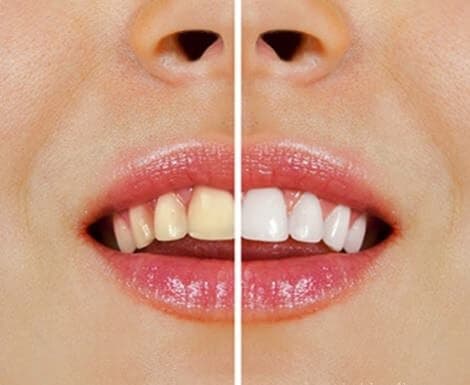 Productos naturales para blanquear los dientes