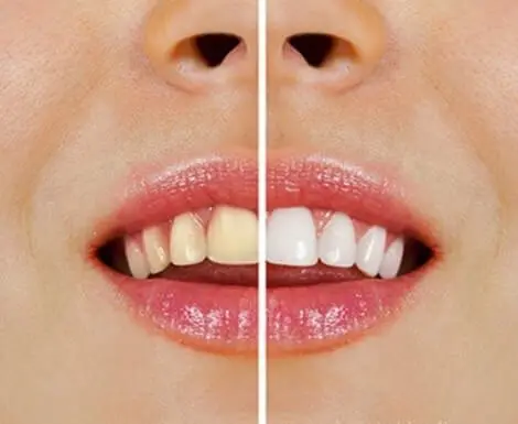 Productos naturales para blanquear los dientes