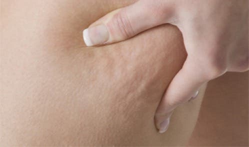 Masajes que pueden ayudar a combatir la celulitis