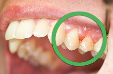 Remedios naturales para encías sangrantes o dentaduras flojas