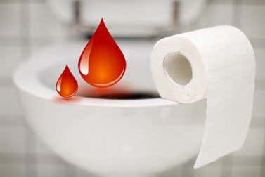 Consejos para prevenir la aparición de las hemorroides