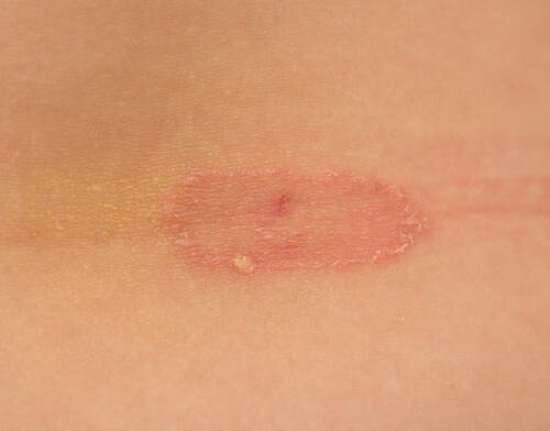 blastomicosis