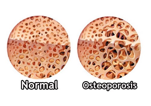 Cómo controlar la osteoporosis durante la menopausia