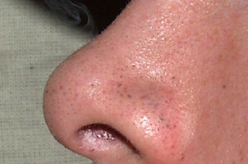 7 tips para eliminar los puntos negros del rostro con rapidez