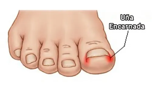 ¿Cómo evitar las uñas encarnadas?