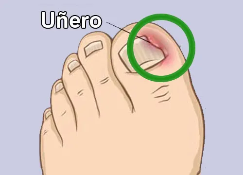 ¿Cómo curamos naturalmente los uñeros?