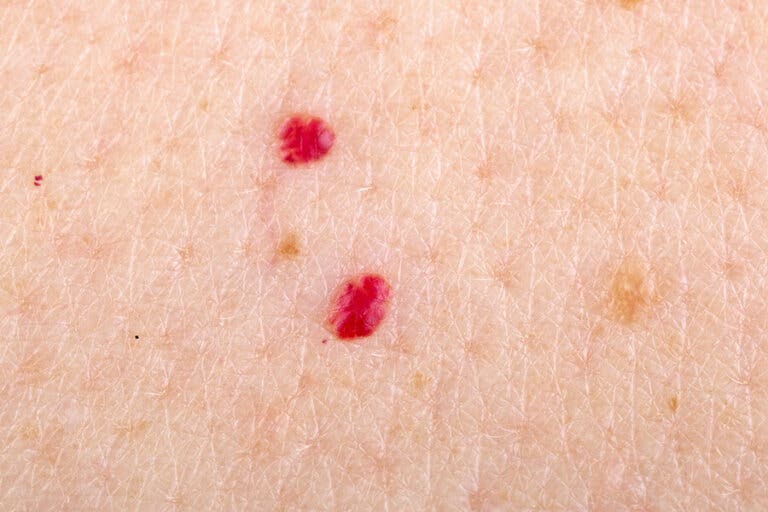 ¿Cómo quitar los lunares de sangre?