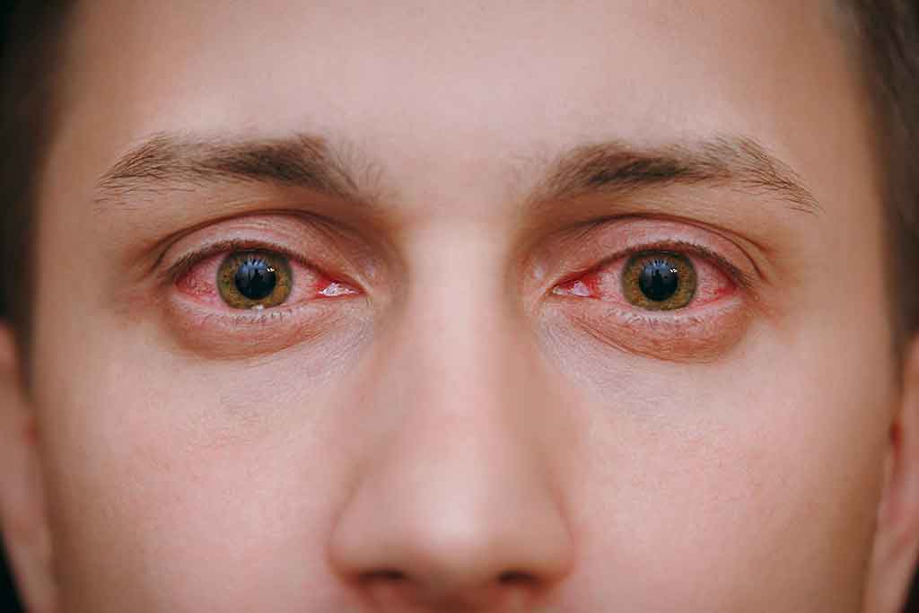 Olhos vermelhos de usar pilocarpina.