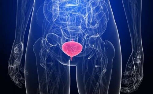 Mujer con cistitis.