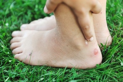 Lingüística escalar interior Remedios para los pies inflamados y con rozaduras - Mejor con Salud