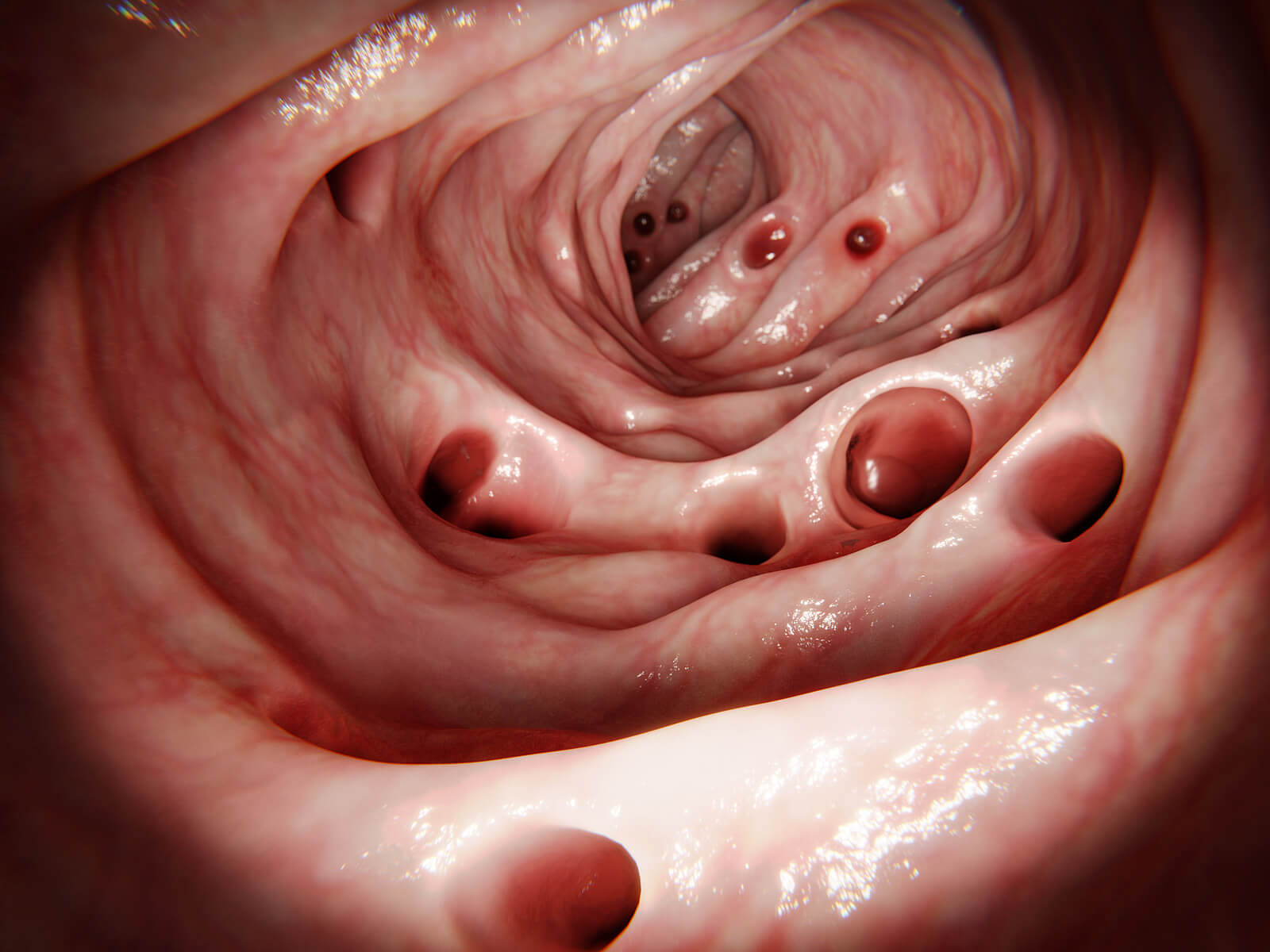 Divertículas en el intestino grueso.