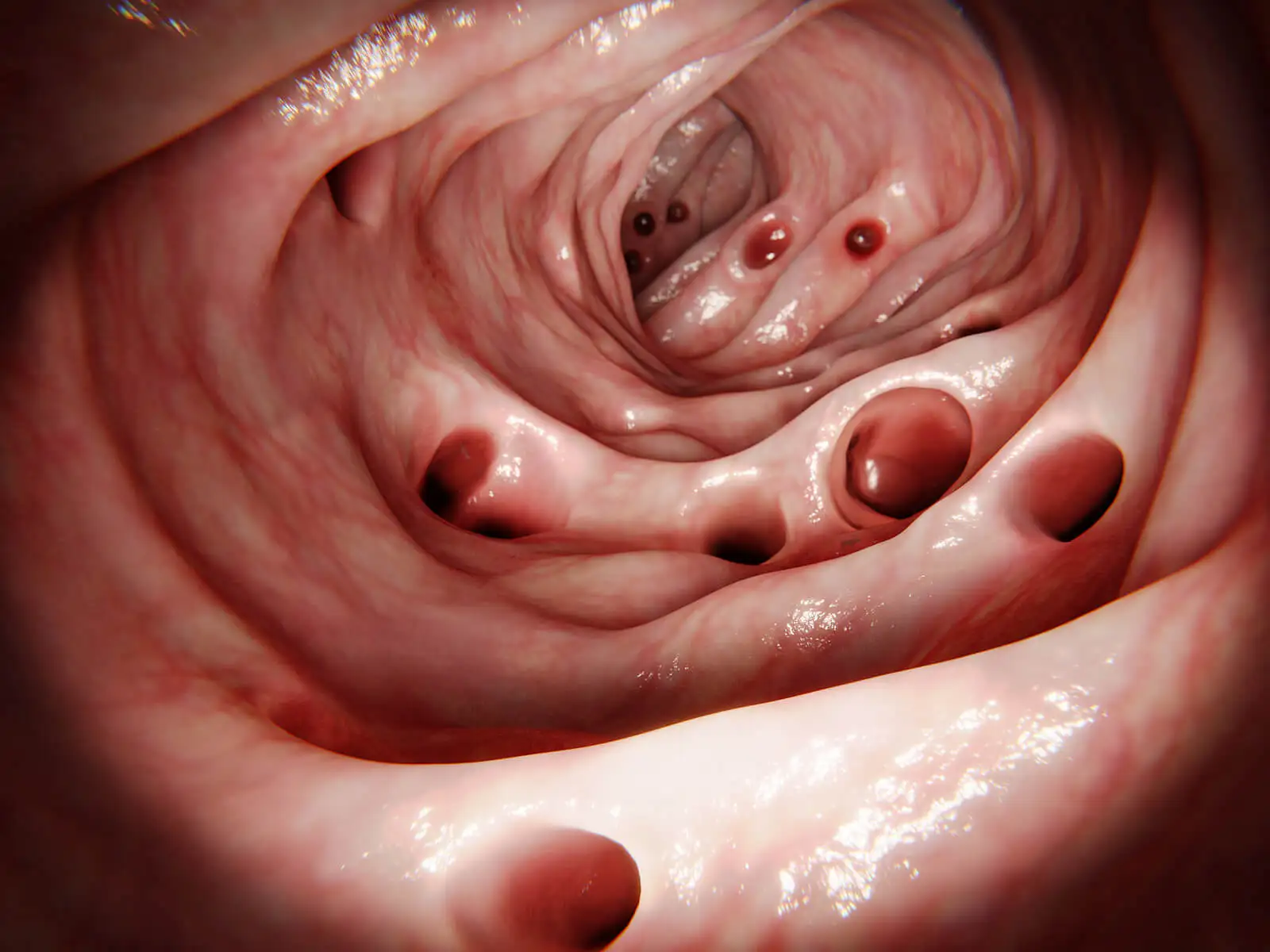 Diverticulitis.