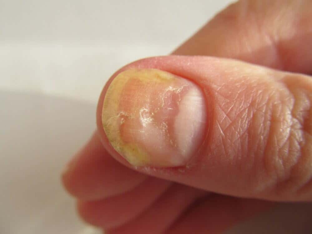 Onicomicosis en las uñas de las manos.