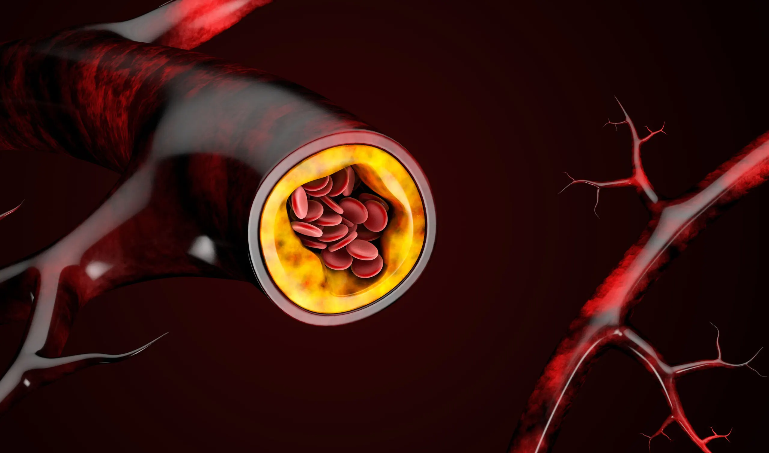 An atheroma plaque.