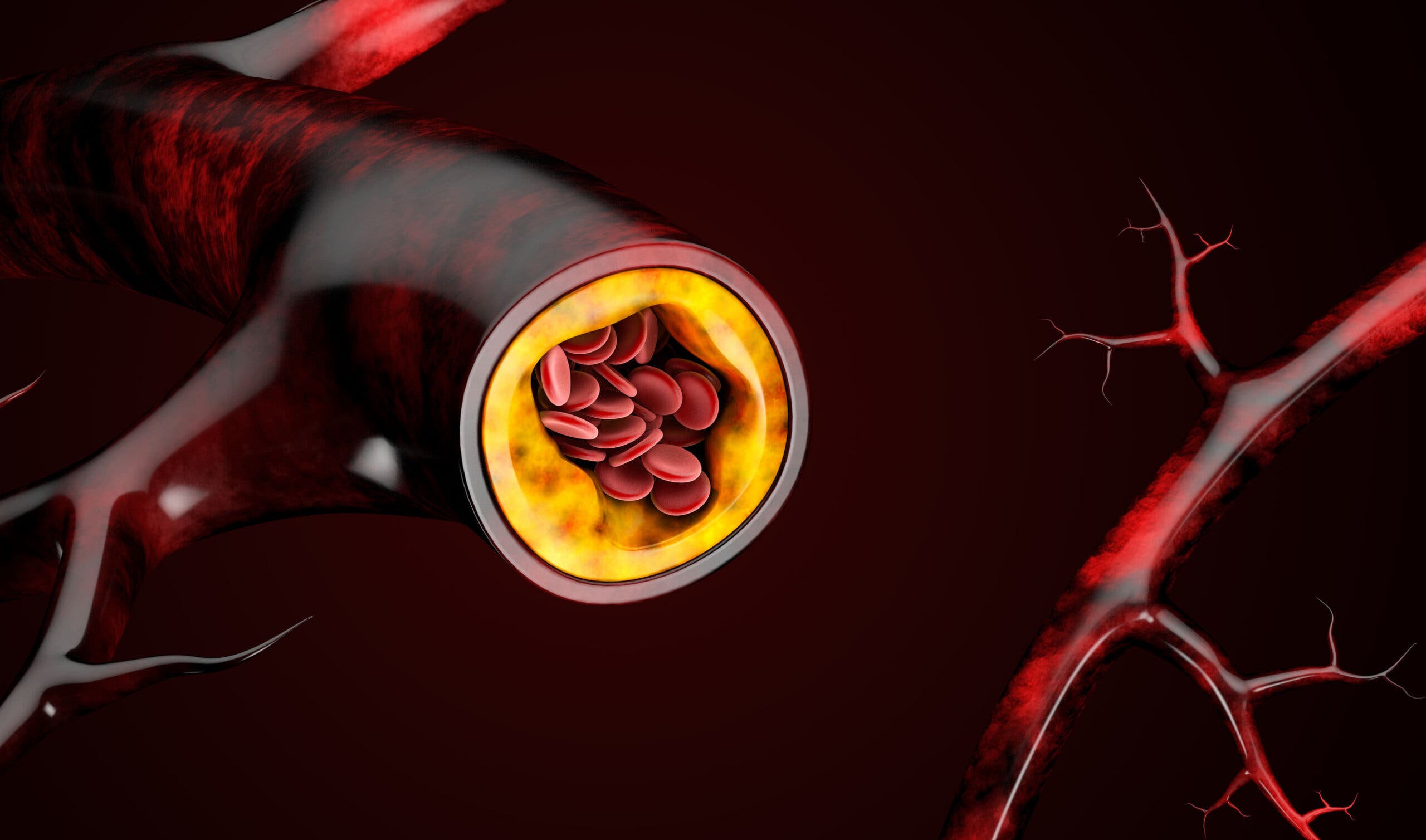 El consumo elevado de triglicéridos puede provocar aterosclerosis.