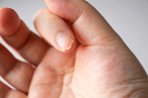 ¿Por qué se descaman las uñas? Causas, tratamientos y soluciones