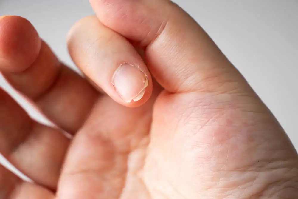 ¿Por qué se descaman las uñas?