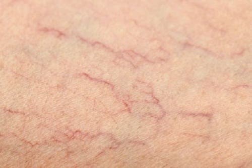 Remedios para las arañas vasculares de las piernas