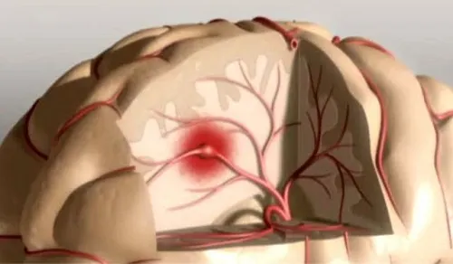 Ictus cerebral
