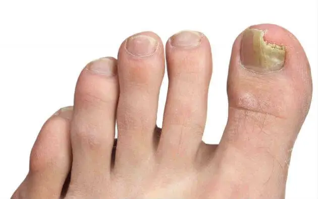 Consejos para prevenir los hongos en los pies