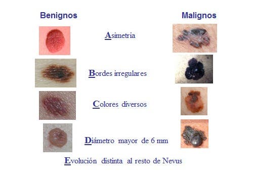 Melanomas