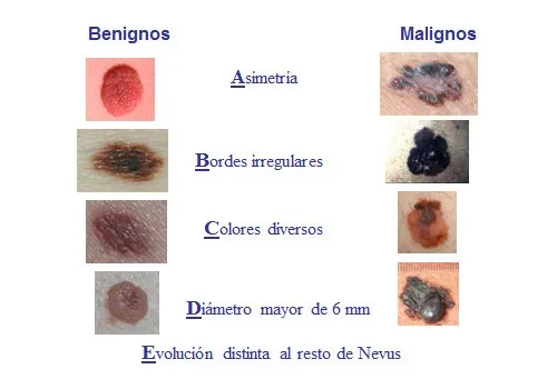 Melanomas