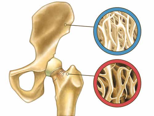 Cómo prevenir una fractura por osteoporosis