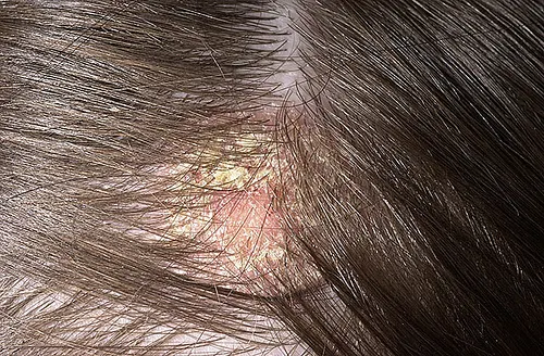dermatitis seborreica tratamientos