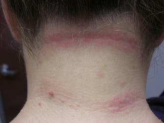 Tratamientos efectivos para la dermatitis seborreica