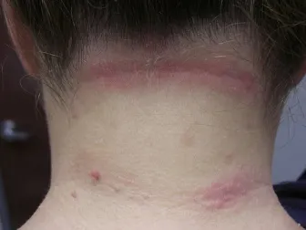 Tratamientos efectivos para la dermatitis seborreica