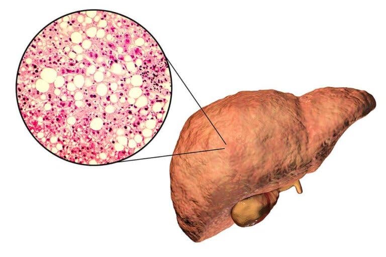 Plantas medicinales para combatir el hígado graso