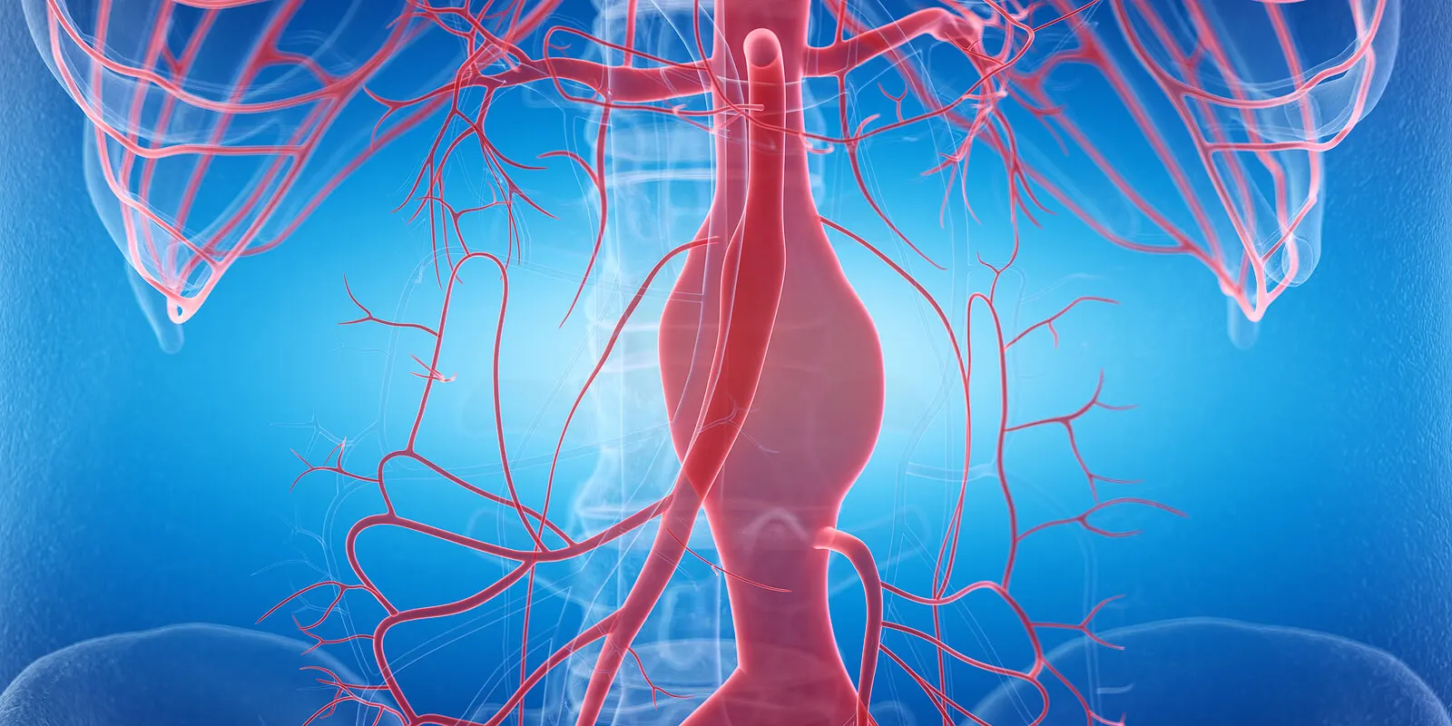 Aneurisma por hipertensión arterial.