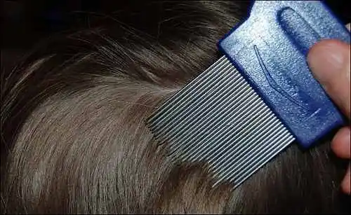9 remedios caseros para eliminar los piojos