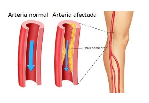 Remedios herbales para la arteriosclerosis