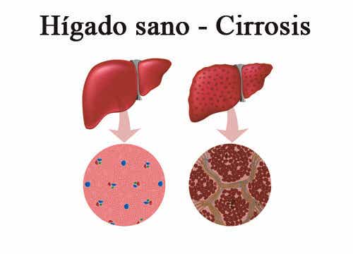 Cirrosis: causas, prevención y remedios naturales