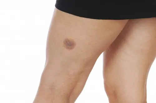 Hematoma cremas antiinflamatorias