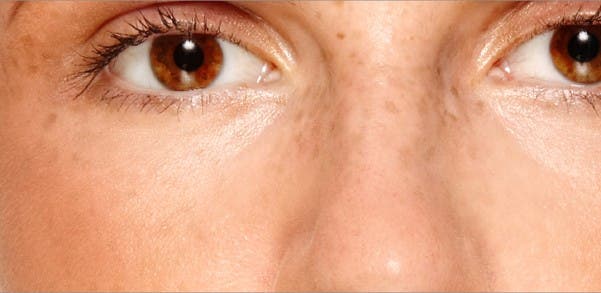 es-posible-reducir-las-manchas-por-melasma