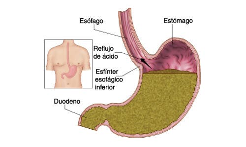 Cómo evitar el reflujo gástrico de forma natural