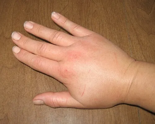 Infusiones para tratar la retención de líquidos