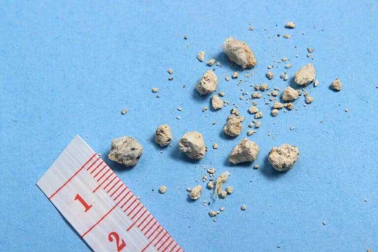 ¿Cómo debe ser la dieta para prevenir los cálculos renales?