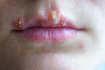 Herpes labial: ¿existen remedios naturales para aliviarlo?
