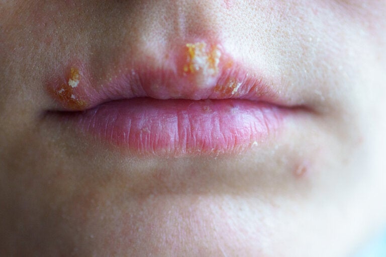10 tratamientos naturales contra el herpes labial