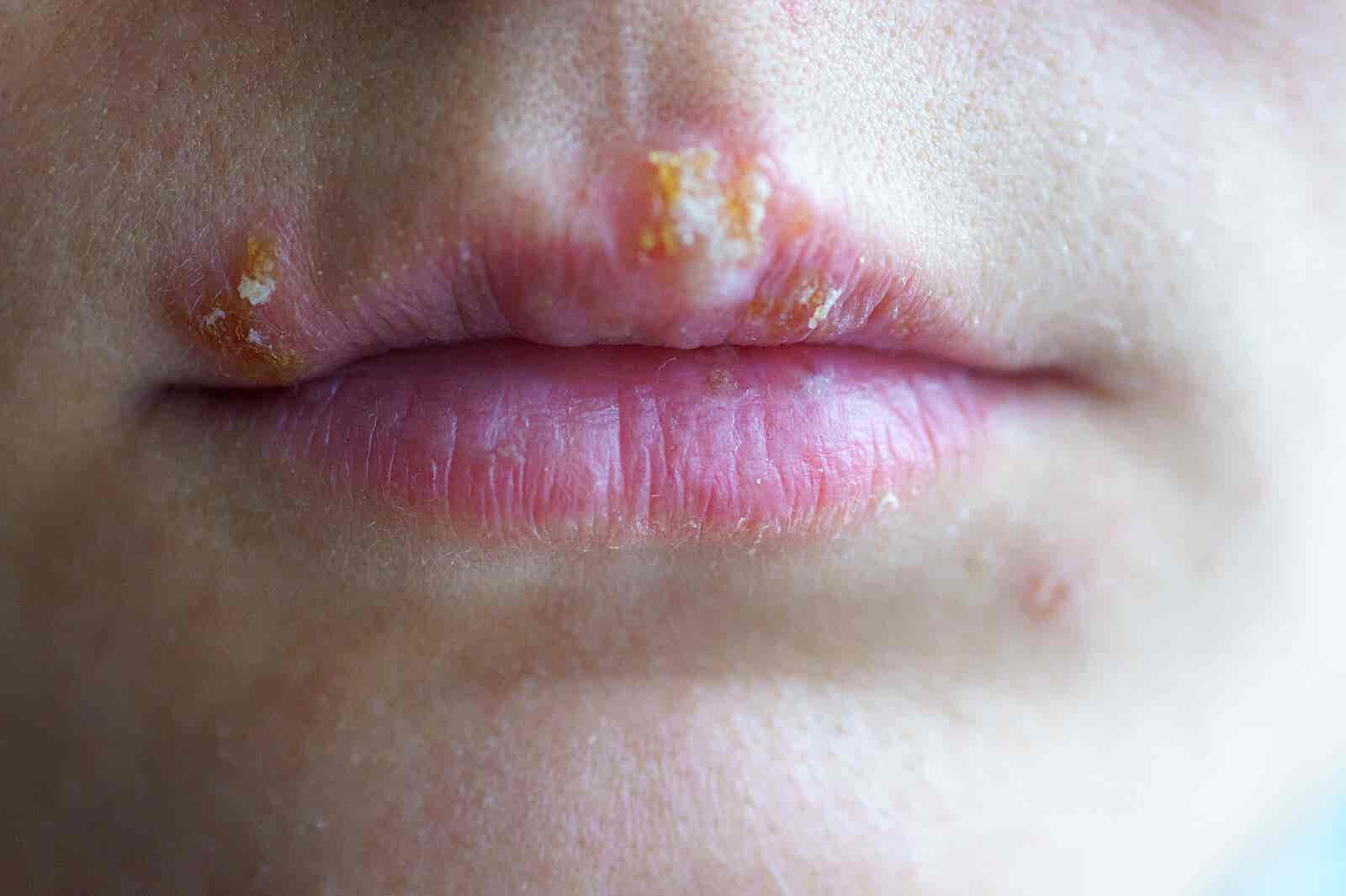 Herpes on the lips.