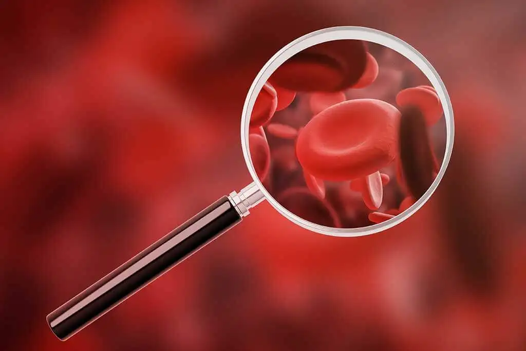 Diabetes con anemia altera resultado de glucosa promedio estimada.