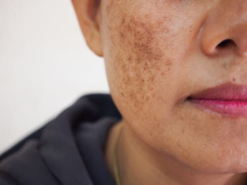 Consideraciones al querer eliminar las manchas de la piel