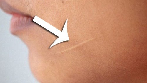 ¿Es posible quitar cicatrices de la piel?