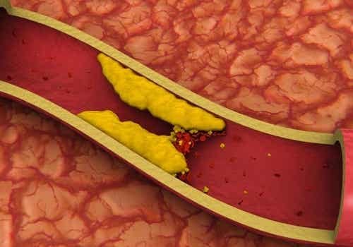 Cómo controlar el colesterol alto de forma natural