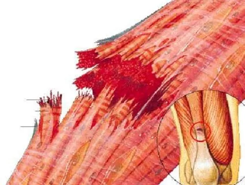 Cómo tratar un desgarro muscular